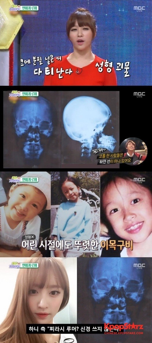 HaNi公开了CT照和儿时照片