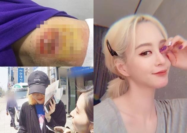 韩艺瑟割脂瘤时遇上医疗事故 两度公开的伤口情况十分震惊