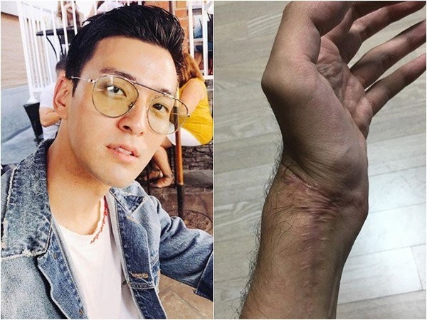 james复原状况不乐观 被迫得重新考虑是否需要截肢