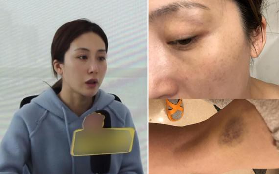 当事人周美毅面对媒体向外界袒露被骗婚始末：遭暴力夺子首晒受伤证据