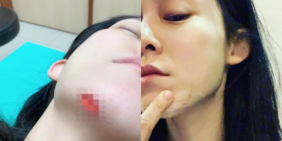 范玮琪社交网站发文称自己摔倒流血，这次撞伤下巴位置，还晒照给大家看